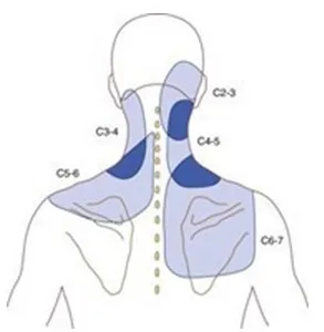 Dolor articular - Imagen 1 Dolor de hombro o cuello