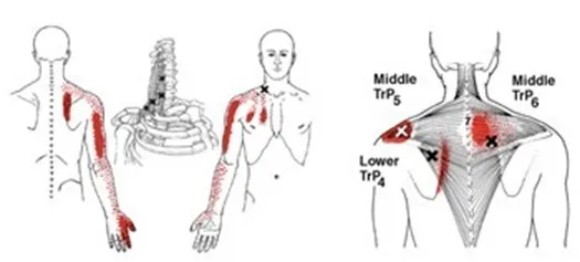 Dolor muscular - Imagen 4 Dolor de hombro o cuello