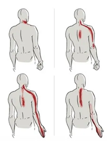 Dolor radicular - Imagen 2 Dolor de hombro o cuello